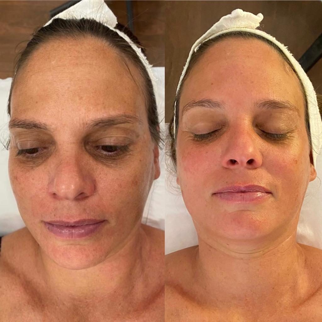שרון לוטן עור הפנים לפני ואחרי טיפול